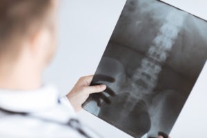 Jacksonville Spinal Injury Lawyer