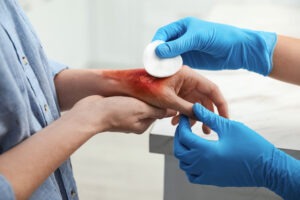 Florida Burn Injury Lawyer