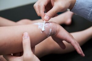 Sarasota Burn Injury Lawyer