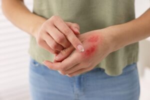Middleton Burn Injury Lawyer