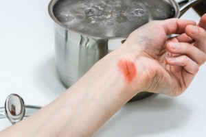 Lake Worth Beach Burn Injury Lawyer